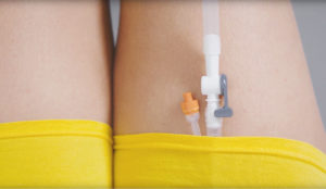 Catheter valve on leg
